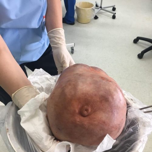 Онко хирурзите от КОЦ-Бургас с уникална операция: Отстраниха 10-килограмов тумор от гърдата на жена